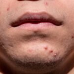 acne, shin, dermatology, skin, puberty, teen, young, treatment, medicine, sickness, remedy, health, cosmetics, acne, acne, acne, acne, acne