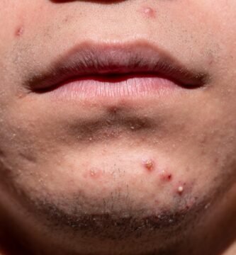 acne, shin, dermatology, skin, puberty, teen, young, treatment, medicine, sickness, remedy, health, cosmetics, acne, acne, acne, acne, acne