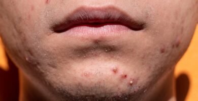 acne, shin, dermatology, skin, puberty, teen, young, treatment, medicine, sickness, remedy, health, cosmetics, acne, acne, acne, acne, acne